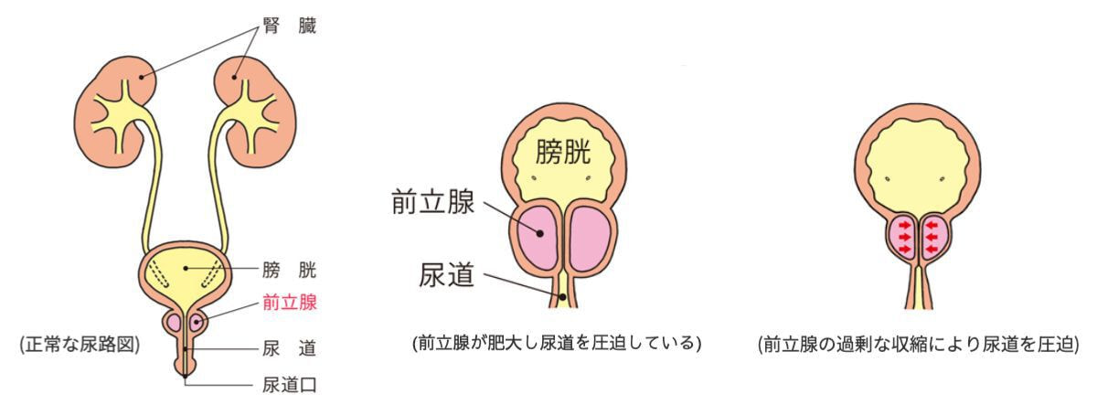 前立腺肥大症（図１）