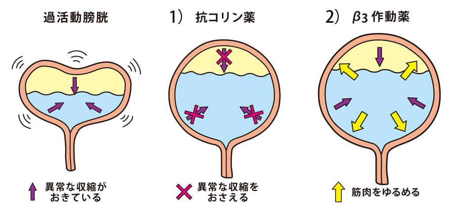 過活動膀胱（図２）